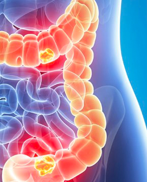 Detección de Cáncer Gastrointestinal